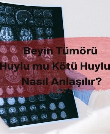 Beyin Tümörü: İyi Huylu mu Kötü Huylu mu? Nasıl Anlaşılır?