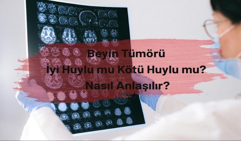 Beyin Tümörü: İyi Huylu mu Kötü Huylu mu? Nasıl Anlaşılır?
